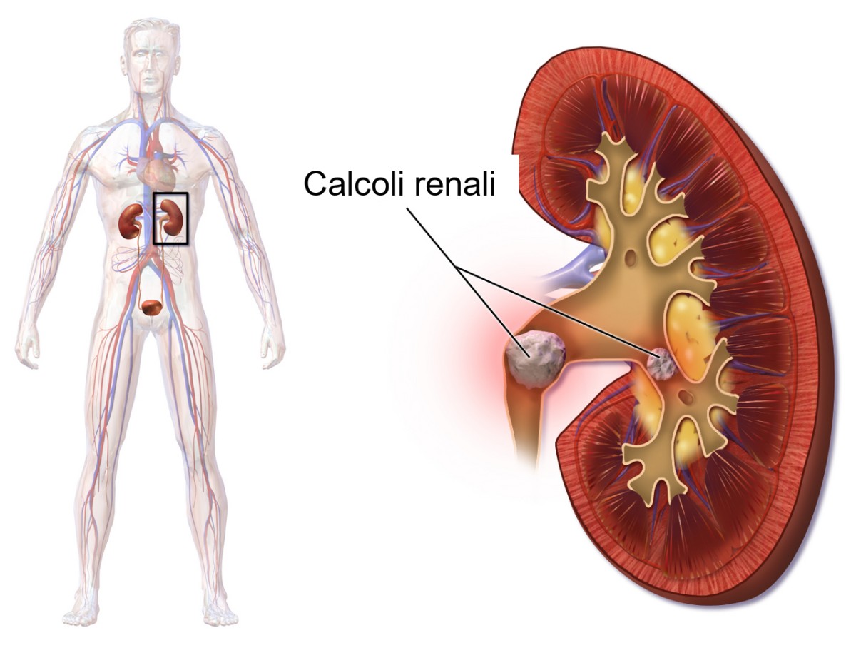 Calcoli all'interno delle vie escretrici del rene in sezione