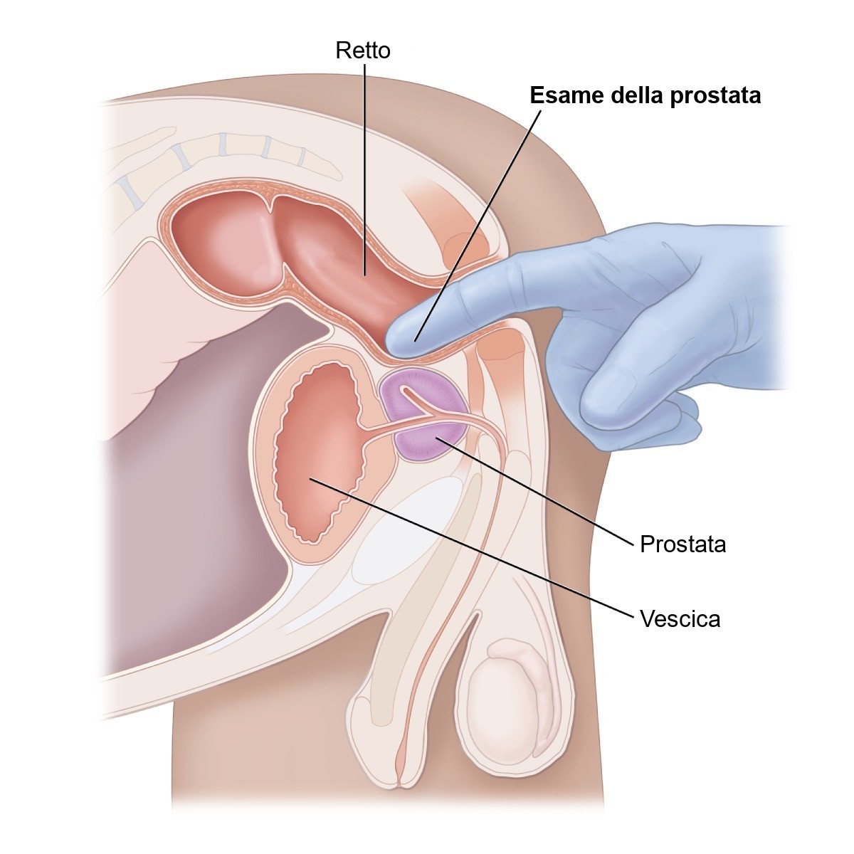 Schema dell'esplorazione rettale digitale per valutare la prostata