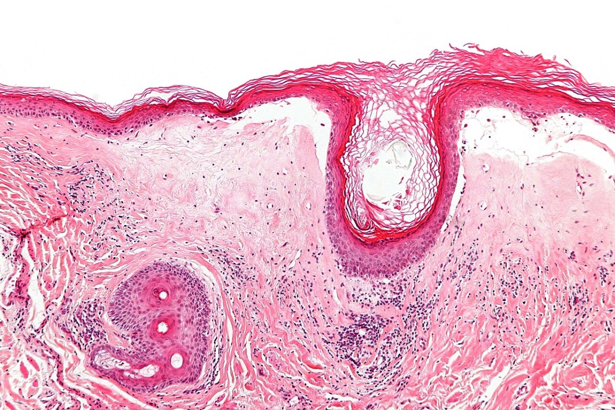 Preparato istologico di lichen sclerosus con atrofia dell'epidermide