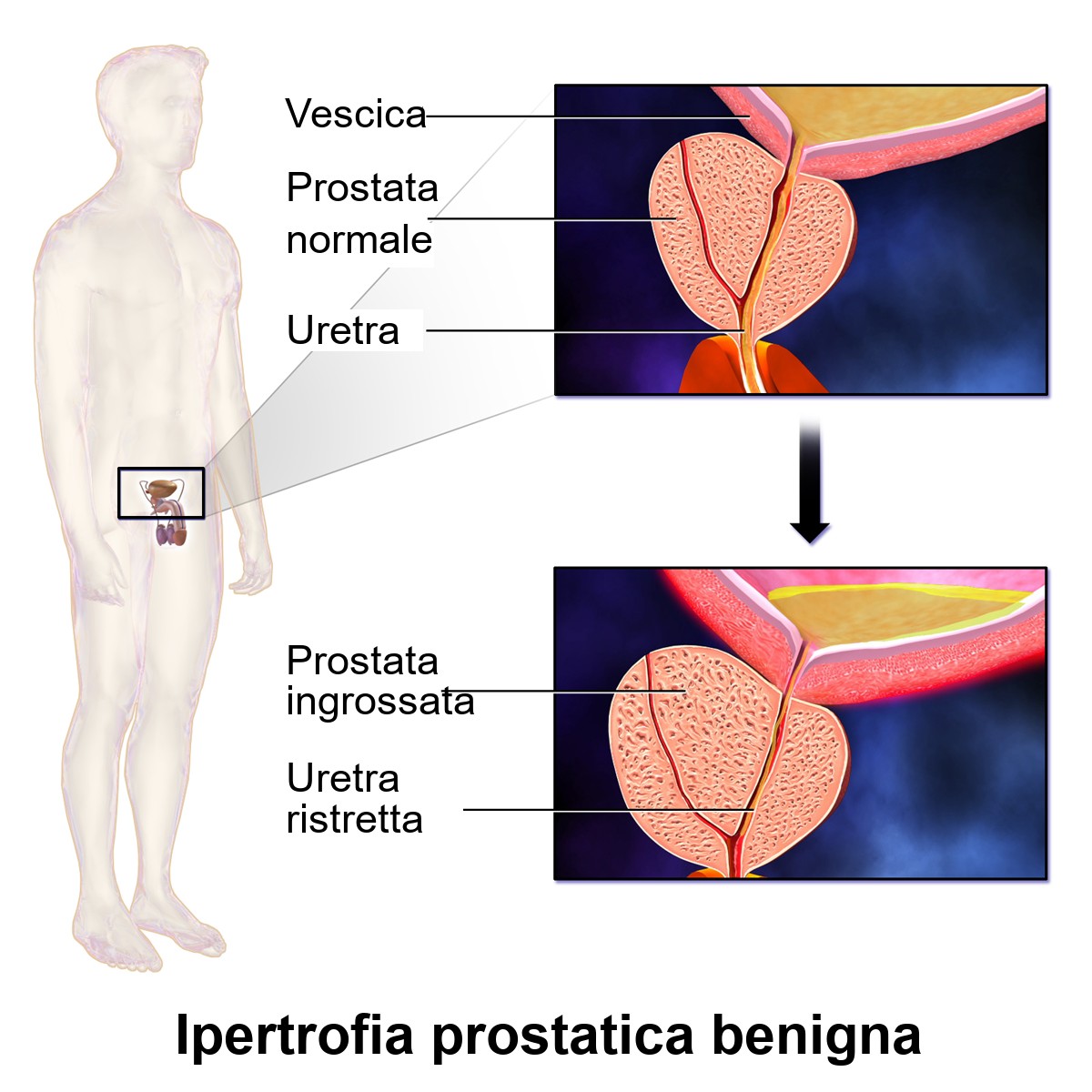 Confronto tra prostata normale e prostata ingrossata che restringe l'uretra