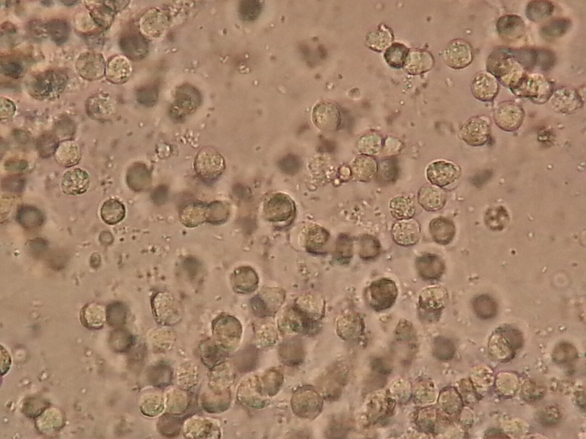 Leucociti e batteri nel sedimento urinario osservato al microscopio