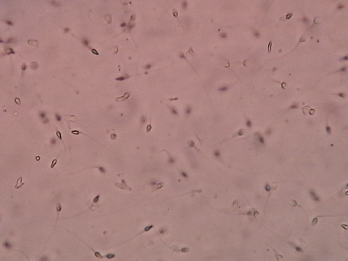 Spermatozoi osservati al microscopio durante l'analisi del liquido seminale