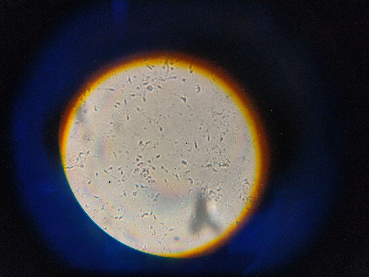 Campo microscopico di liquido seminale durante lo spermiogramma
