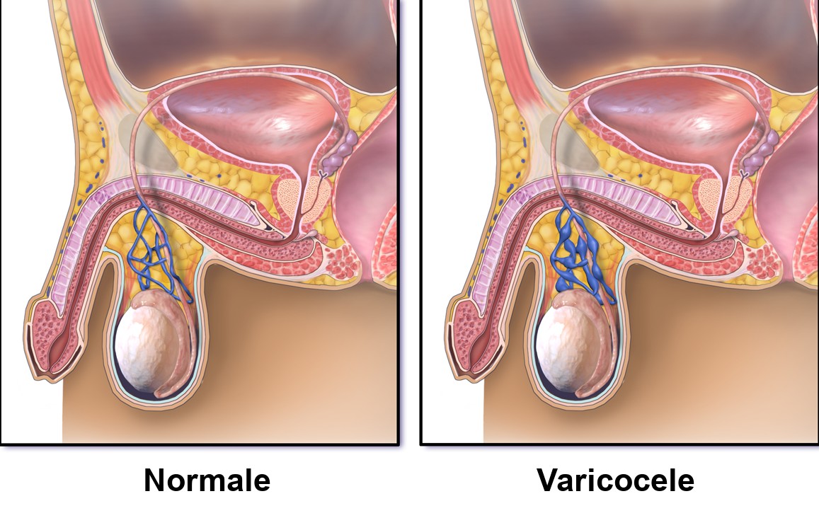 Confronto fra vene spermatiche normali e vene dilatate nel varicocele