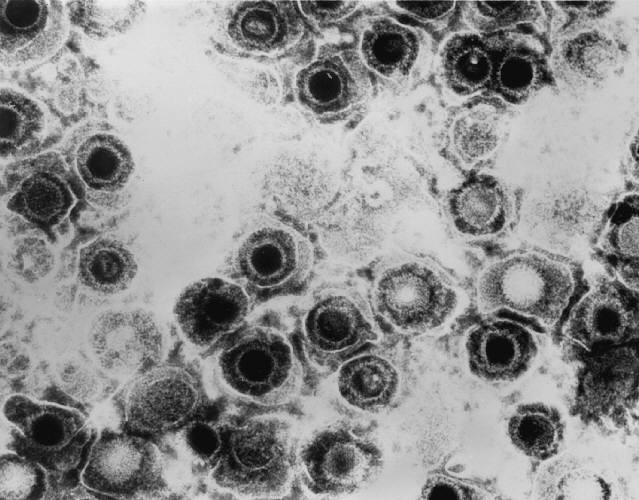 Virioni di herpes simplex al microscopio elettronico